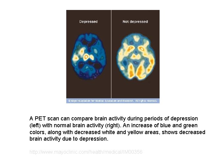 A PET scan compare brain activity during periods of depression (left) with normal brain