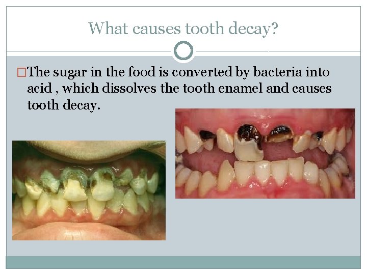 What causes tooth decay? �The sugar in the food is converted by bacteria into