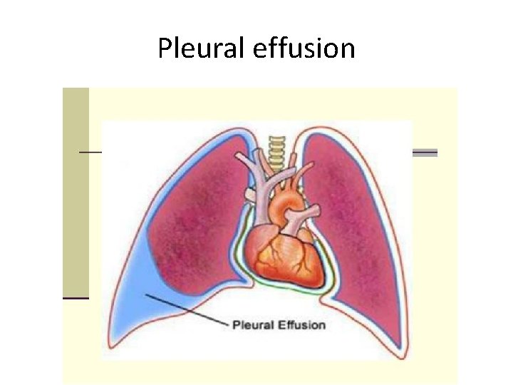 Pleural effusion 