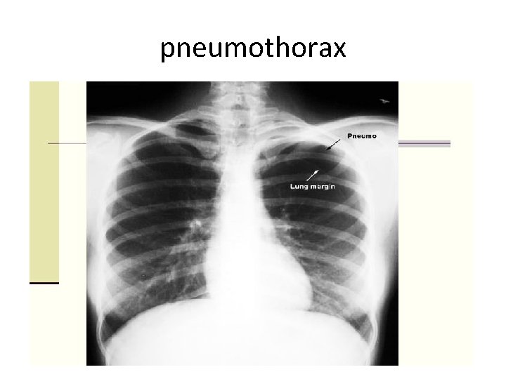 pneumothorax 