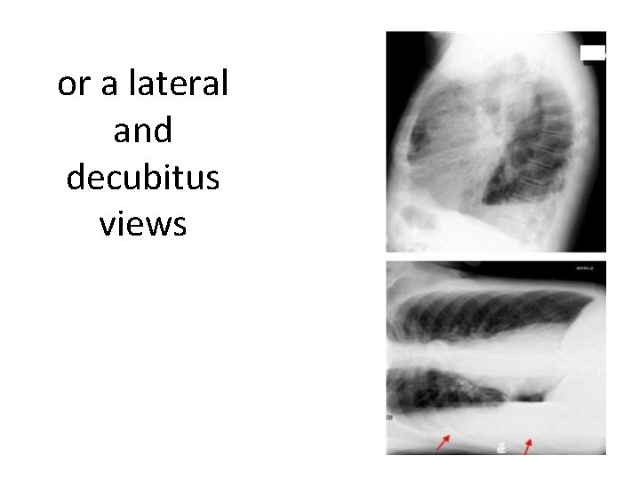 or a lateral and decubitus views 