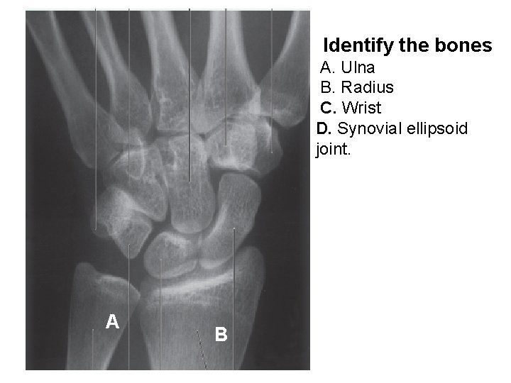 Identify the bones A. Ulna B. Radius C. Wrist D. Synovial ellipsoid joint. A