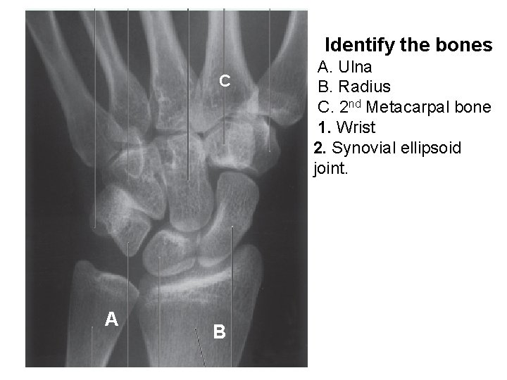 Identify the bones C A B A. Ulna B. Radius C. 2 nd Metacarpal