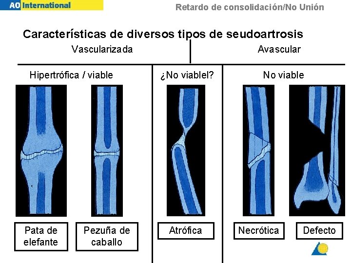 Retardo de consolidación/No Unión Características de diversos tipos de seudoartrosis Vascularizada Hipertrófica / viable