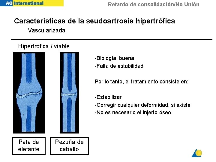 Retardo de consolidación/No Unión Características de la seudoartrosis hipertrófica Vascularizada Hipertrófica / viable -Biología: