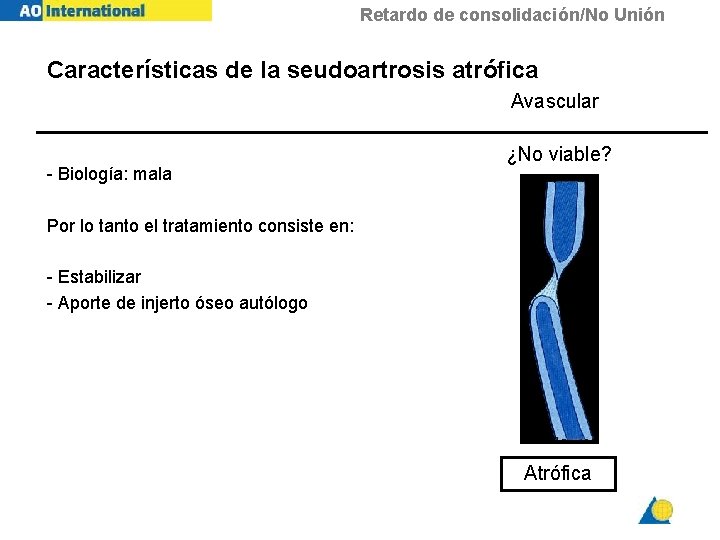 Retardo de consolidación/No Unión Características de la seudoartrosis atrófica Avascular - Biología: mala ¿No