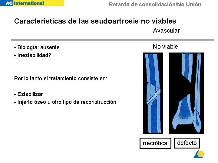 Retardo de consolidación/No Unión Características de las seudoartrosis no viables Avascular - Biología: ausente