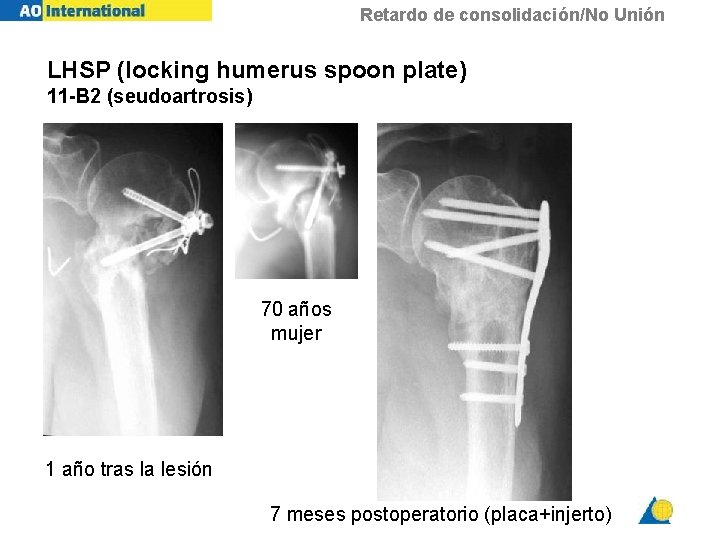 Retardo de consolidación/No Unión LHSP (locking humerus spoon plate) 11 -B 2 (seudoartrosis) 70