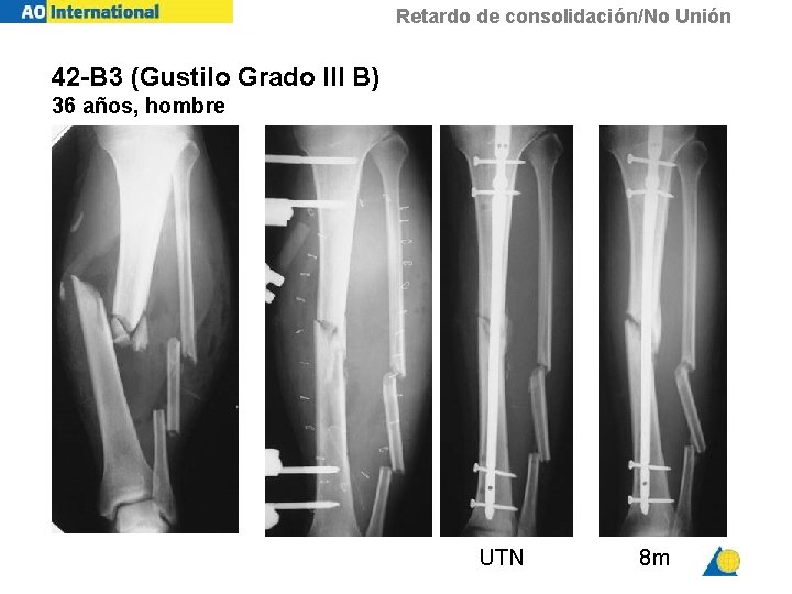 Retardo de consolidación/No Unión 42 -B 3 (Gustilo Grado III B) 36 años, hombre