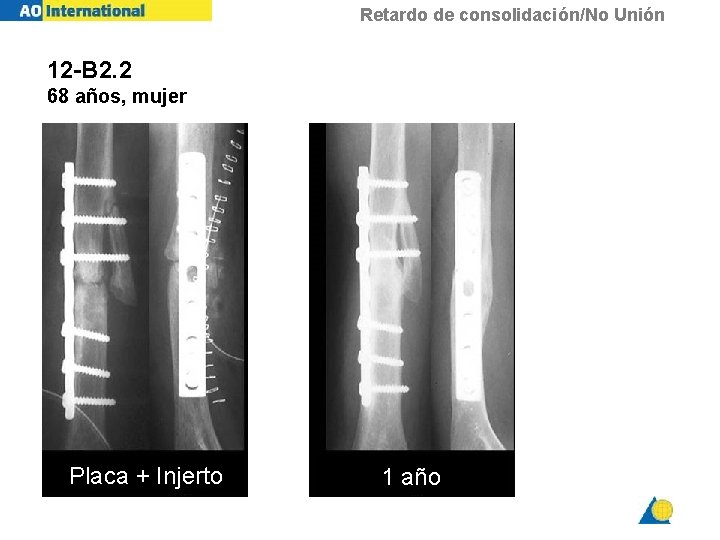 Retardo de consolidación/No Unión 12 -B 2. 2 68 años, mujer Placa + Injerto