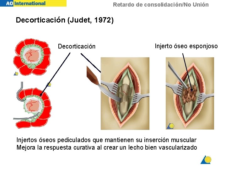 Retardo de consolidación/No Unión Decorticación (Judet, 1972) Decorticación Injerto óseo esponjoso Injertos óseos pediculados