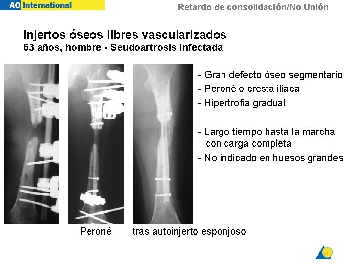 Retardo de consolidación/No Unión Injertos óseos libres vascularizados 63 años, hombre - Seudoartrosis infectada