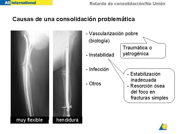 Retardo de consolidación/No Unión Causas de una consolidación problemática - Vascularización pobre (biología) Traumática