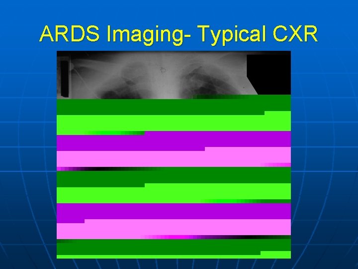 ARDS Imaging- Typical CXR 