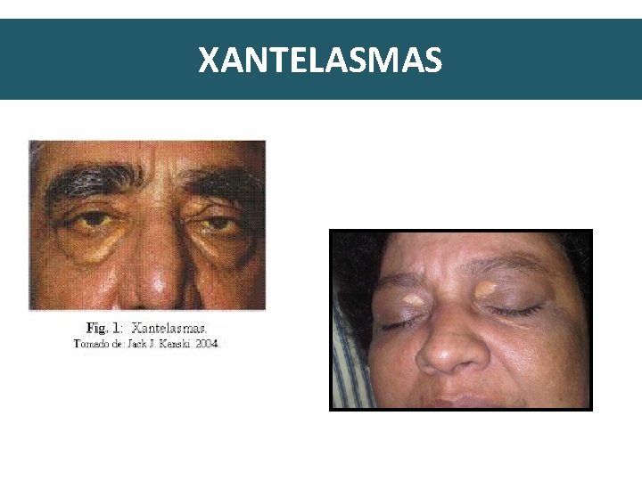 XANTELASMAS 