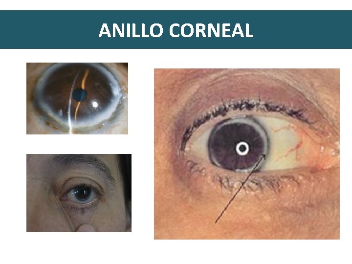 ANILLO CORNEAL 