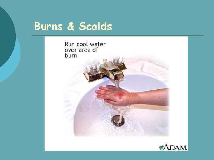 Burns & Scalds 