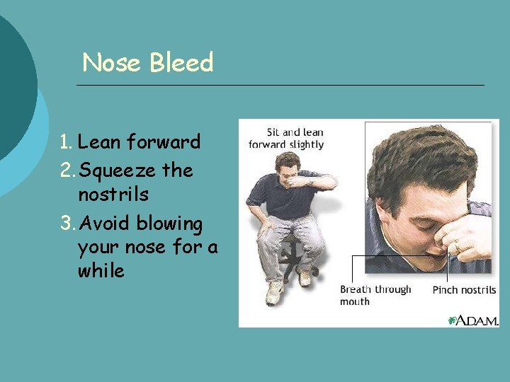 Nose Bleed 1. Lean forward 2. Squeeze the nostrils 3. Avoid blowing your nose