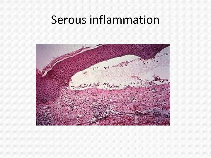 Serous inflammation Serous inflammation