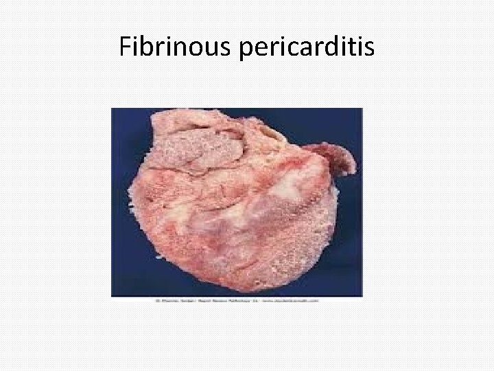 Fibrinous pericarditis 