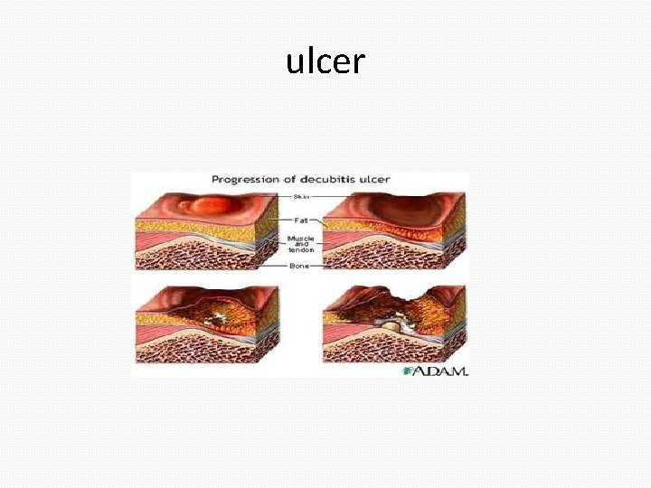 ulcer 