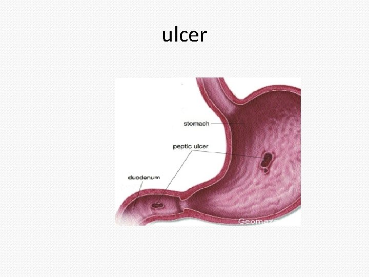 ulcer 