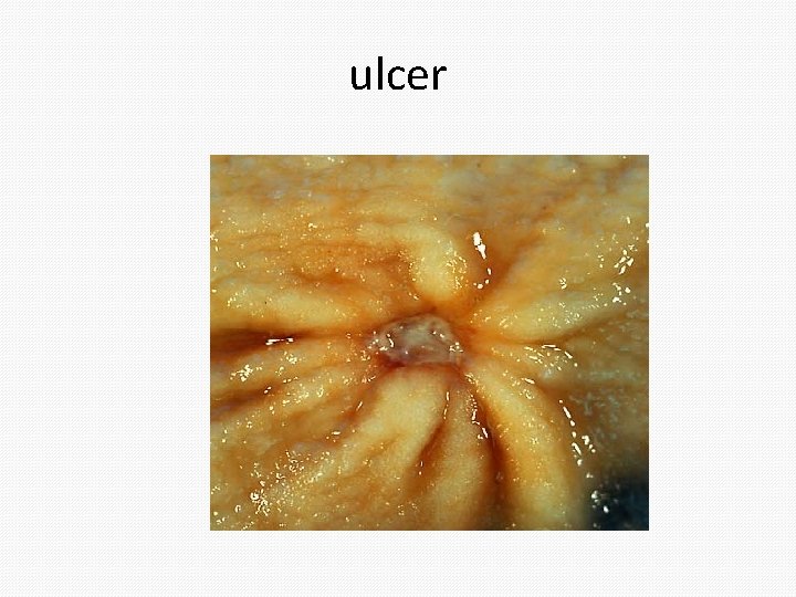 ulcer 