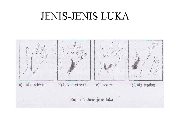 JENIS-JENIS LUKA 