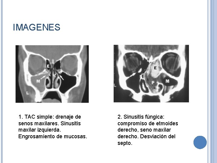 IMAGENES 1. TAC simple: drenaje de senos maxilares. Sinusitis maxilar izquierda. Engrosamiento de mucosas.