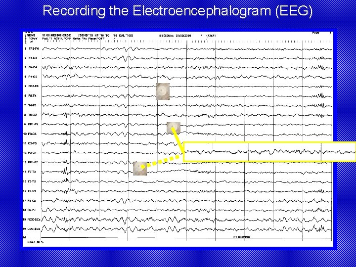 Recording the Electroencephalogram (EEG) 