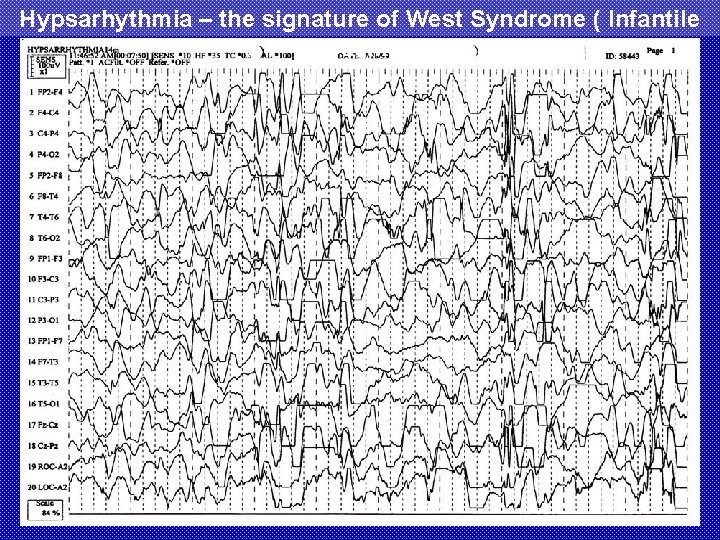 Hypsarhythmia – the signature of West Syndrome ( Infantile Spasms) 