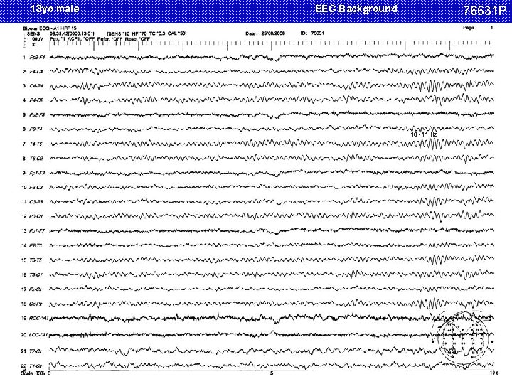 13 yo male EEG Background 76631 P 10 -11 Hz 