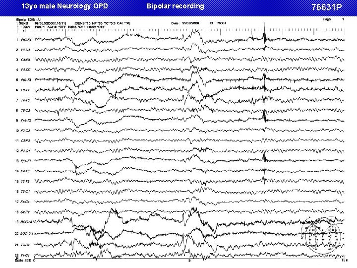 13 yo male Neurology OPD Bipolar recording 76631 P 