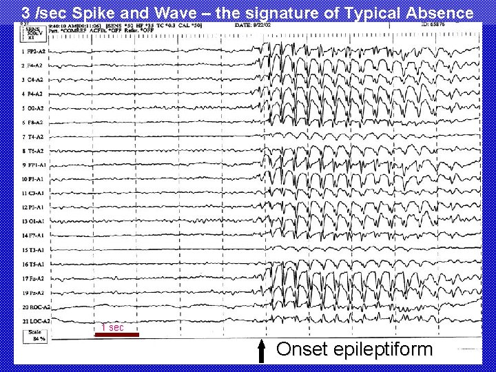 3 /sec Spike and Wave – the signature of Typical Absence Seizures 1 sec