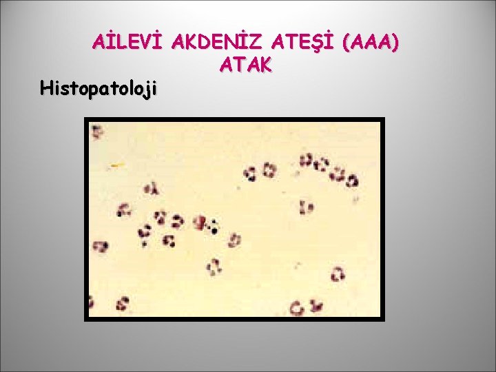 AİLEVİ AKDENİZ ATEŞİ (AAA) ATAK Histopatoloji 