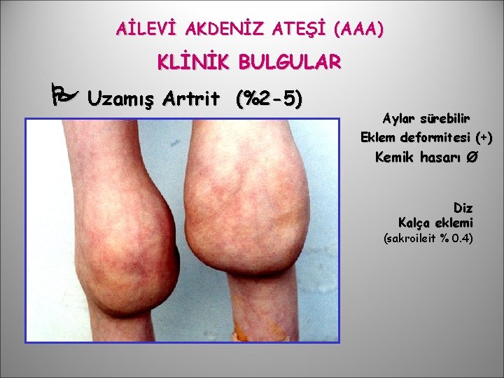 AİLEVİ AKDENİZ ATEŞİ (AAA) KLİNİK BULGULAR Uzamış Artrit (%2 -5) Aylar sürebilir Eklem deformitesi