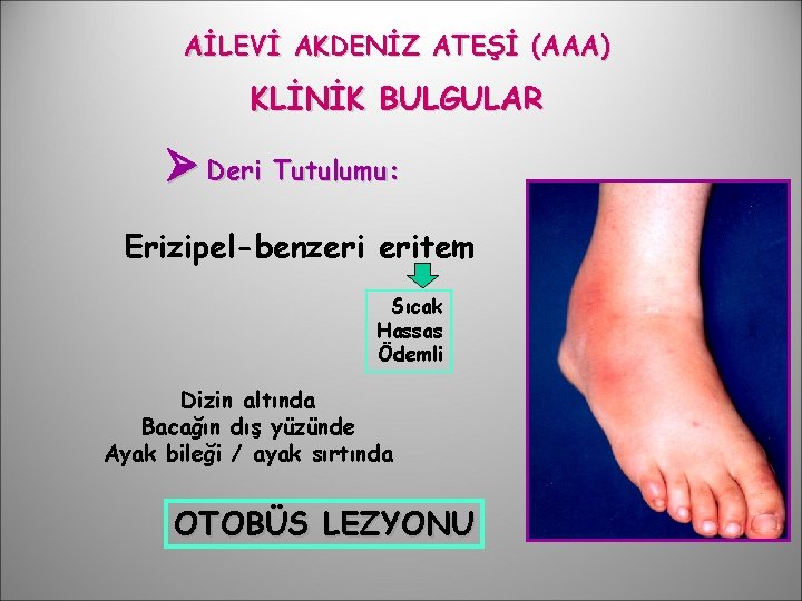 AİLEVİ AKDENİZ ATEŞİ (AAA) KLİNİK BULGULAR Deri Tutulumu: Erizipel-benzeri eritem Sıcak Hassas Ödemli Dizin