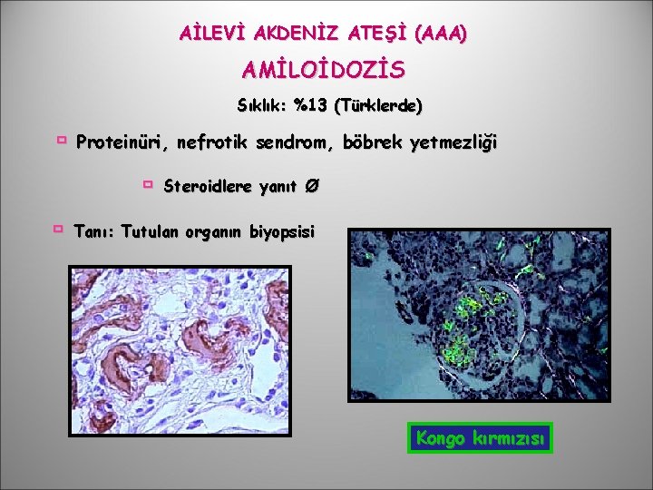 AİLEVİ AKDENİZ ATEŞİ (AAA) AMİLOİDOZİS Sıklık: %13 (Türklerde) Proteinüri, nefrotik sendrom, böbrek yetmezliği Steroidlere