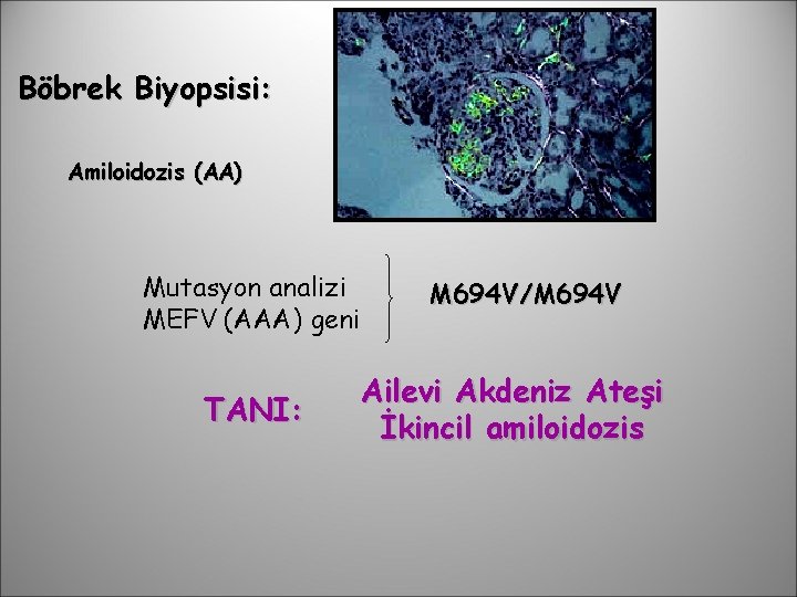 Böbrek Biyopsisi: Amiloidozis (AA) Mutasyon analizi MEFV (AAA) geni TANI: M 694 V/M 694