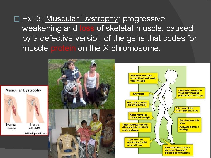 � Ex. 3: Muscular Dystrophy: progressive weakening and loss of skeletal muscle, caused by