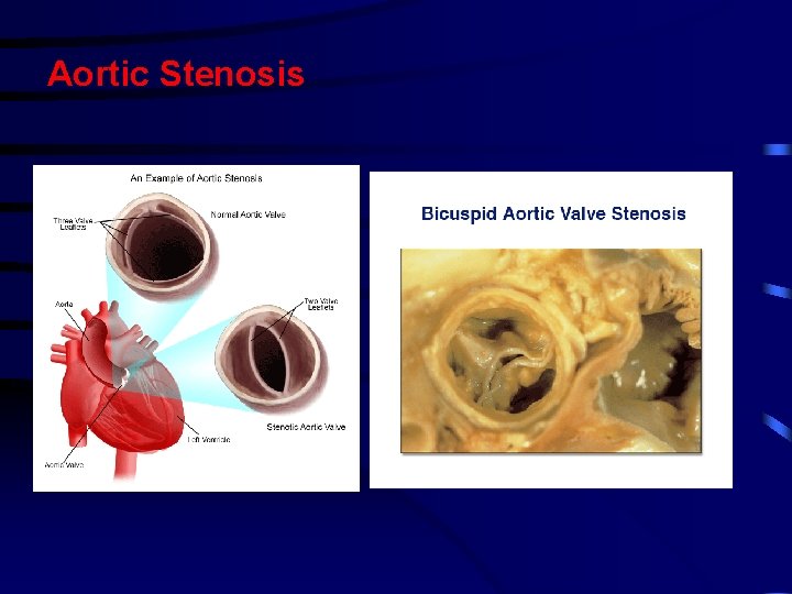 Aortic Stenosis Aortic Stenosis
