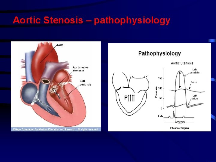 Aortic Stenosis – pathophysiology Aortic Stenosis – pathophysiology