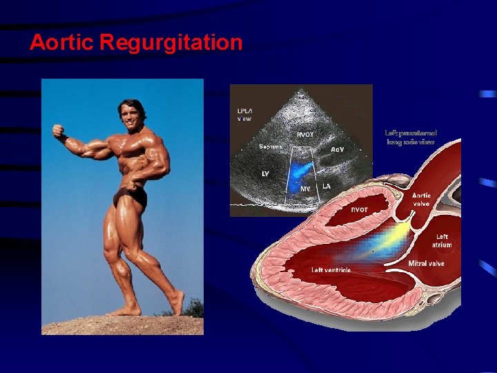 Aortic Regurgitation Aortic Regurgitation
