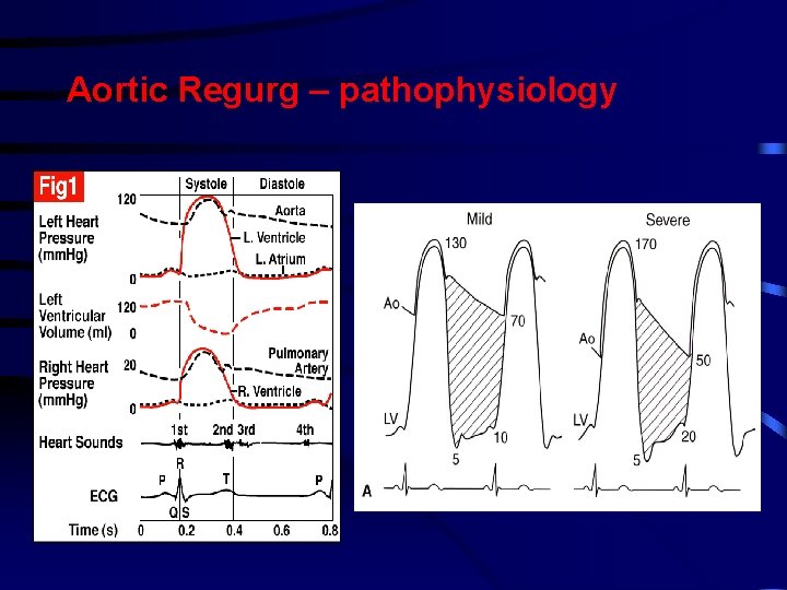 Aortic Regurg – pathophysiology Aortic Regurg – pathophysiology