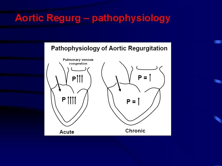 Aortic Regurg – pathophysiology Aortic Regurg – pathophysiology
