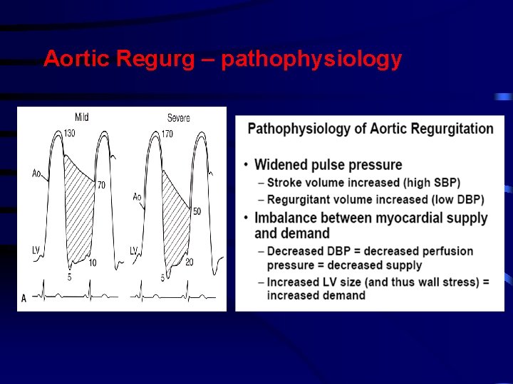 Aortic Regurg – pathophysiology Aortic Regurg – pathophysiology