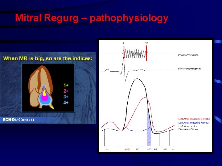 Mitral Regurg – pathophysiology Mitral Regurg – pathophysiology