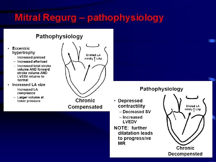 Mitral Regurg – pathophysiology Mitral Regurg – pathophysiology