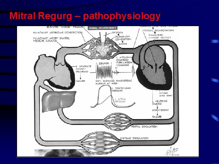 Mitral Regurg – pathophysiology Mitral Regurg – pathophysiology