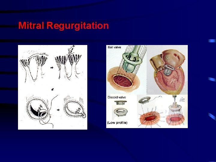 Mitral Regurgitation Mitral Regurgitation